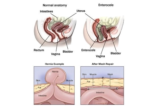 Enterocele